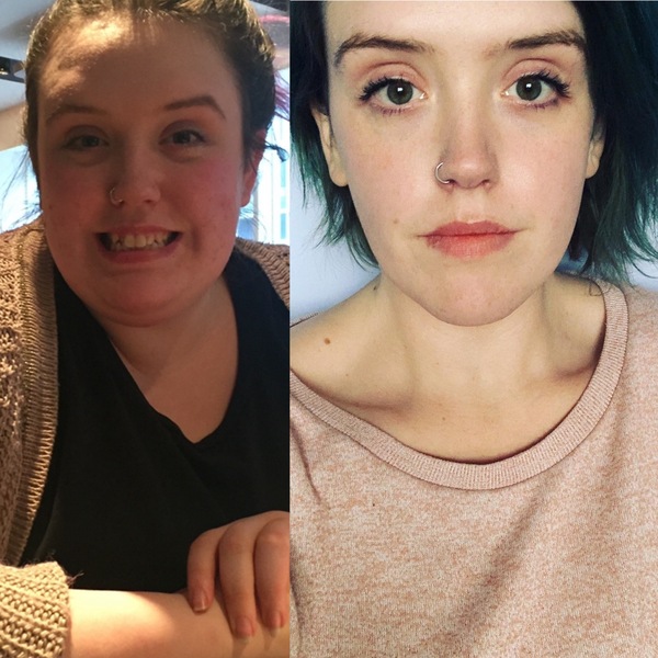 Contemplating bariatric surgery.... advice?