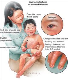 Let’s stop calling it ‘Kawasaki-like’ syndrome