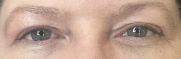 Hooded eye surgery