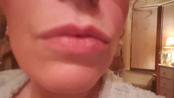 To feel sorry for woman who believe their lip fillers make them more attractive??