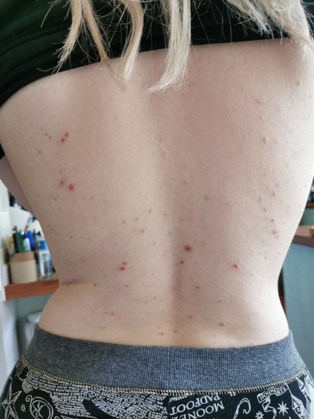 Does this look like a heat rash?