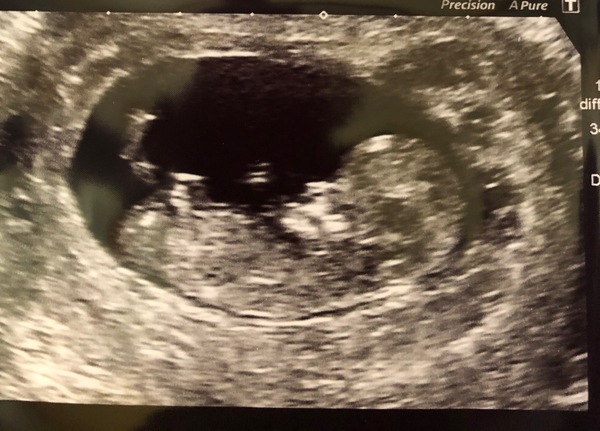 Gender guesses 12 week scan
