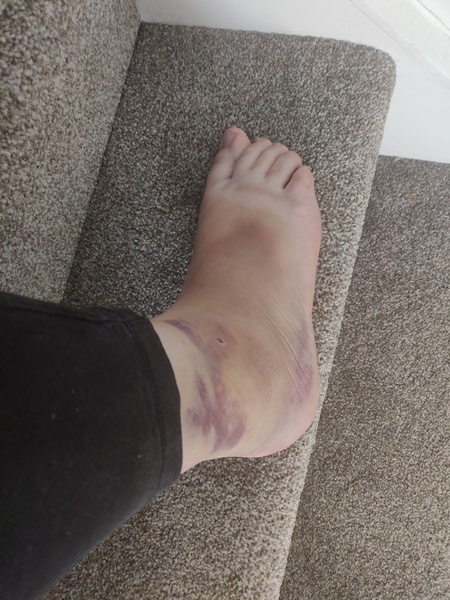 To call in sick with a sprained ankle?
