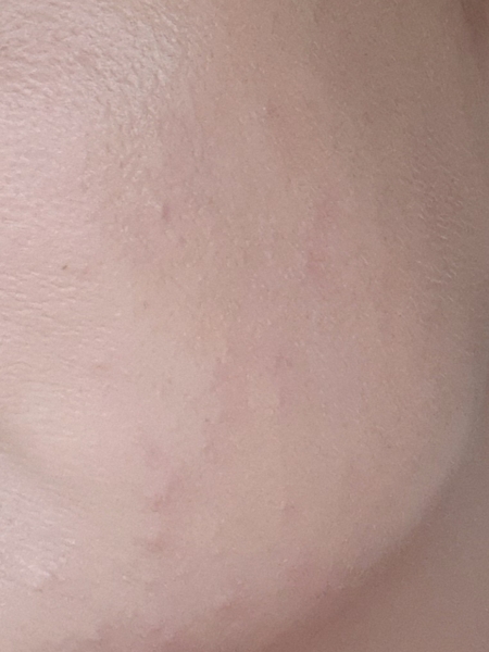 Rash/spots suddenly appeared on face