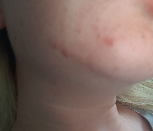 Breaking out for the first time in my mid 20's, help! Is this acne? Picture included