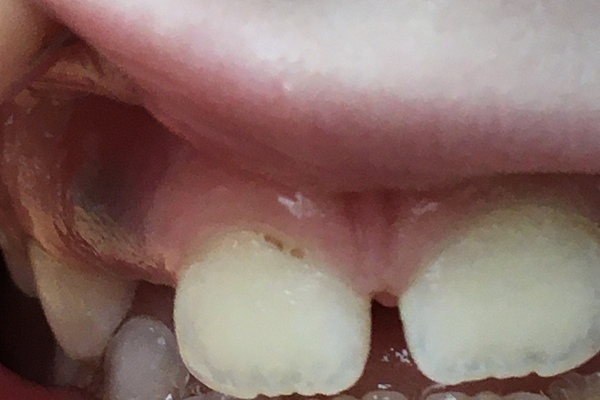 Problem with 7 year olds gum