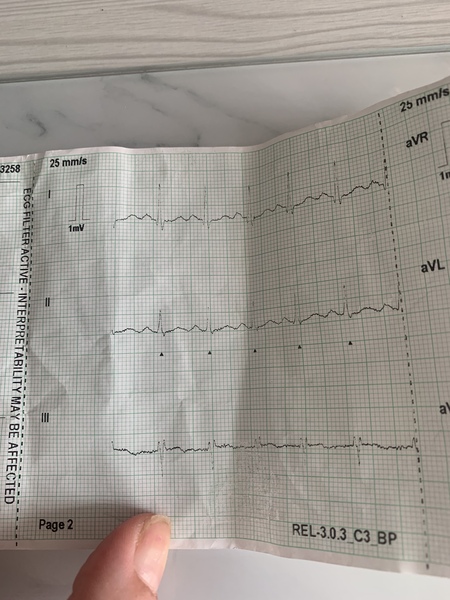 Heart ecg