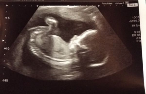 20 week scan guesses