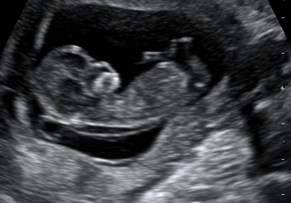 Private scan causing more anxiety