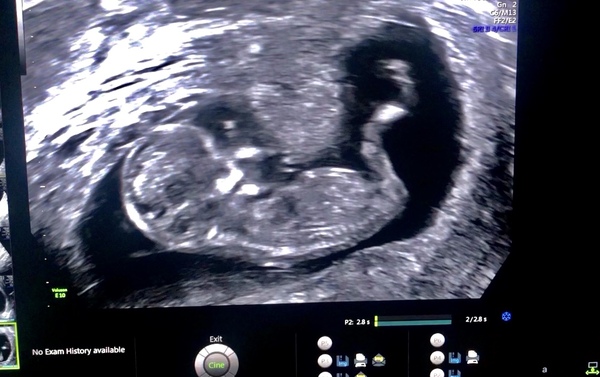 Hi I'm expecting twins. Could someone pls help me with nub theory x