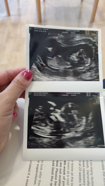 Worrying about 12 weeks scan after 1 MC & MMC