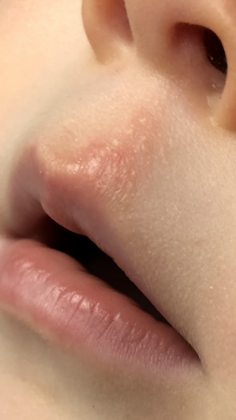Is this a cold sore?