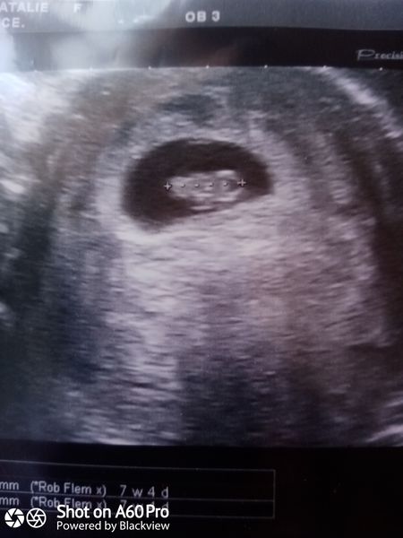 7 week scan