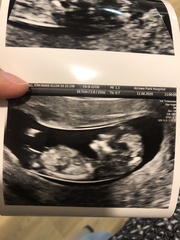 Hi I'm expecting twins. Could someone pls help me with nub theory x