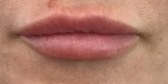 To feel sorry for woman who believe their lip fillers make them more attractive??