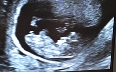 How early for a reassurance / private scan?