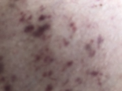 Anyone had this rash pls?