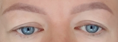 Hooded eye surgery
