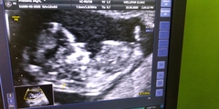 Baby gender guess at 12 weeks
