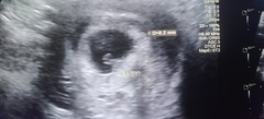 7 week scan pics
