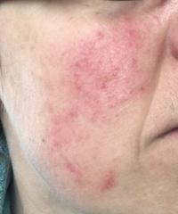 Acne/rosacea - how to clear (pic)