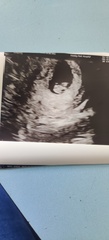 7 week scan pics