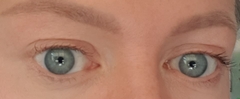 Hooded eye surgery