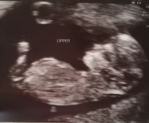 Identical twins gender guess - just for fun!