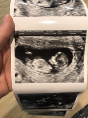 Hi I'm expecting twins. Could someone pls help me with nub theory x