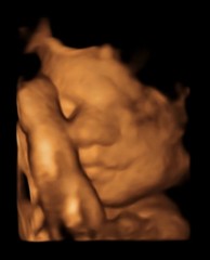3d/4d scan with anterior placenta - worth it?