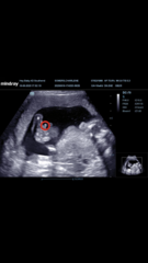 Private scan and gender