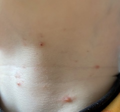 Treatment ideas - molluscum contagiosum?