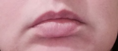 To think you can’t/tell if these lips have fillers? Photo attached