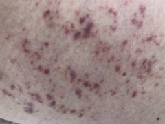 Anyone had this rash pls?