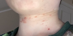 Treatment ideas - molluscum contagiosum?