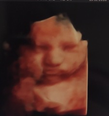 3d/4d scan with anterior placenta - worth it?