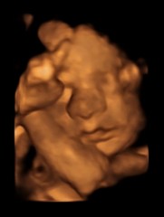 3d/4d scan with anterior placenta - worth it?
