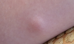 Lump on inner thing?