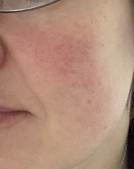 Acne/rosacea - how to clear (pic)