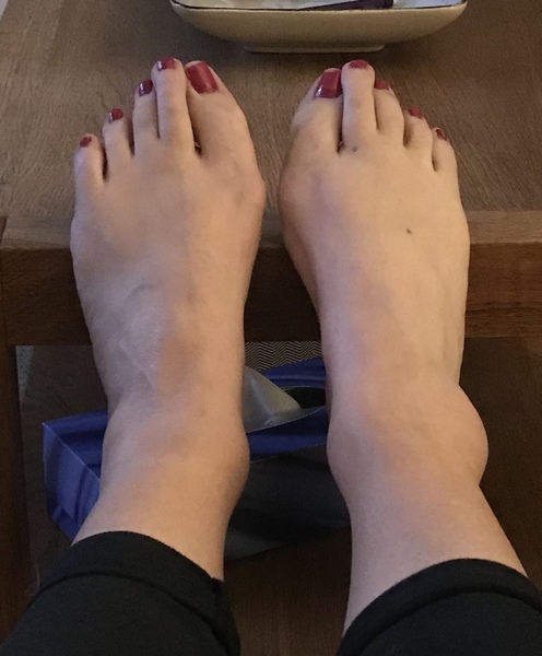 Feet... photo (warning...not pretty)