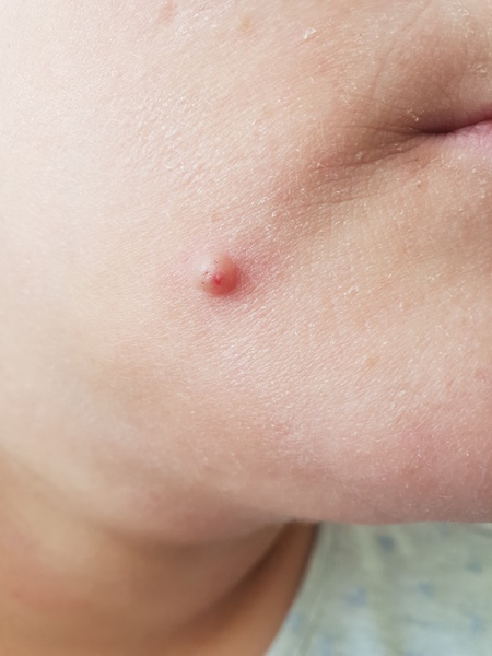 A mole
