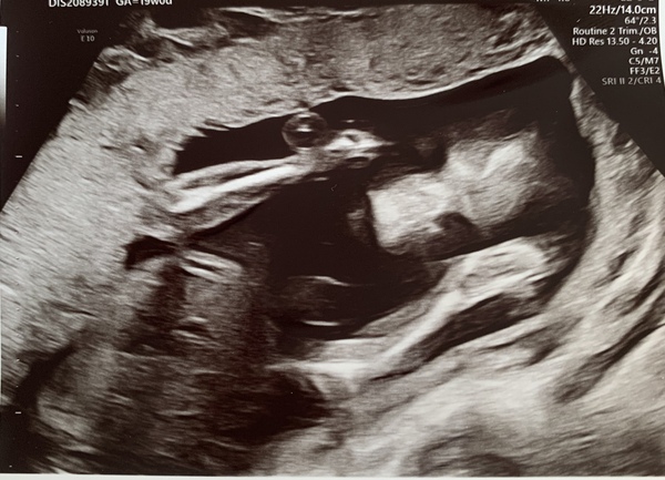 👣 Due Nov/Dec 👣 it's the 20 week scans! 👣