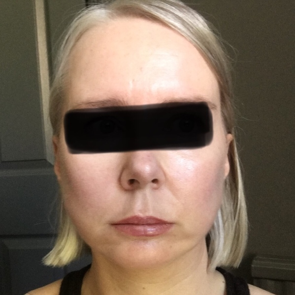 My droopy jowl mini face lift result pics