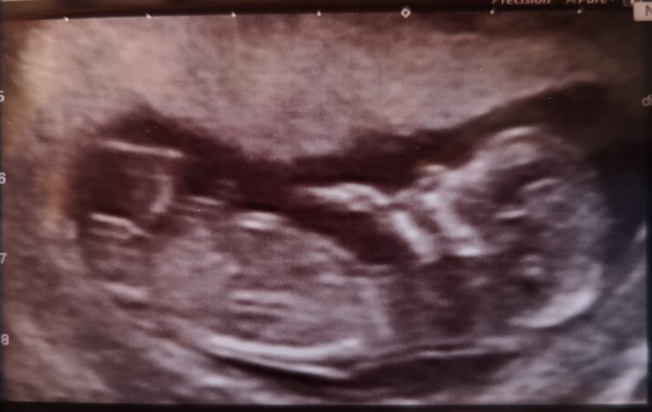 12 week scan, girl or boy? ☺️