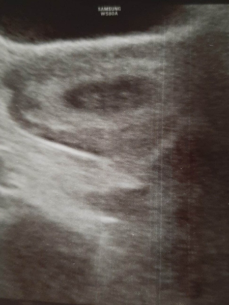 Catching up - TTC after miscarriage part 2