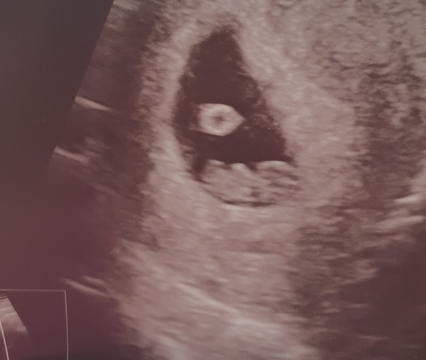 Pregnant after Missed Miscarriage MMC