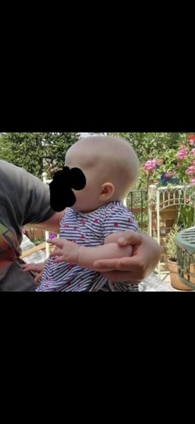 To ask if anyone has experience with - Sagittal Synostosis/Craniosynostosis