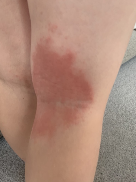 Eczema?