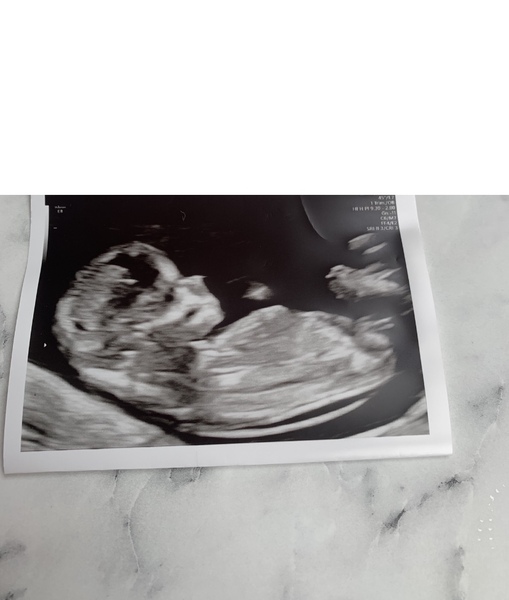 Just for fun - gender guess 12 week scan