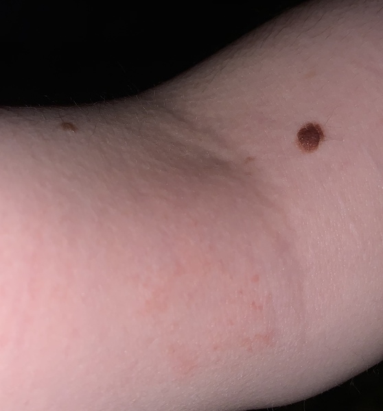 Whats this rash?